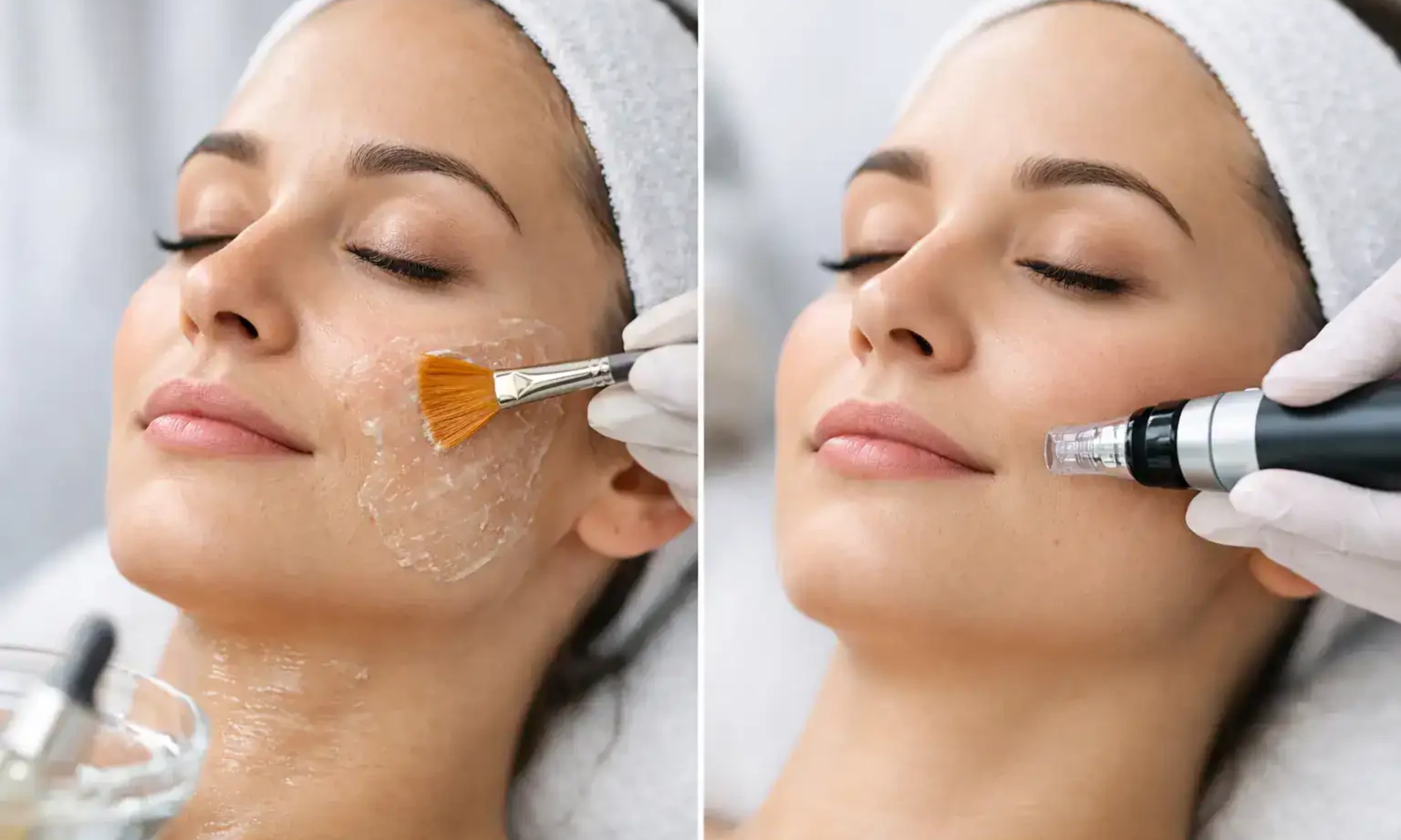 Microneedling or a Chemical Peel? How to Choose the Right Skin Treatment